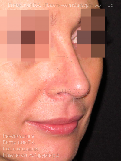 ринопластика, пластический хирург Витвицкий Б. А., результат №186, ракурс 2, фото после операции