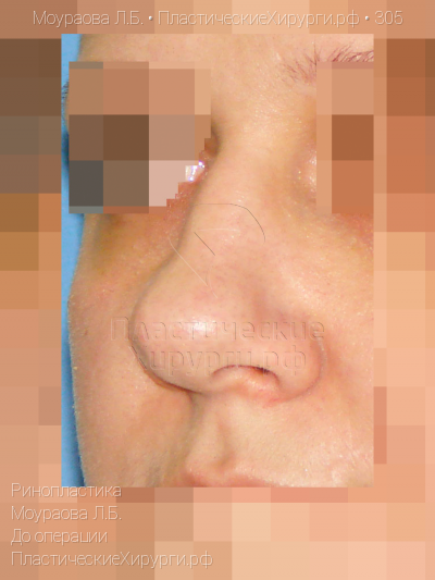 ринопластика, пластический хирург Моураова Л. Б., результат №305, ракурс 4, фото до операции