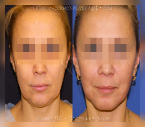 подтяжка лица, результат №339, предварительное изображение до и после операции