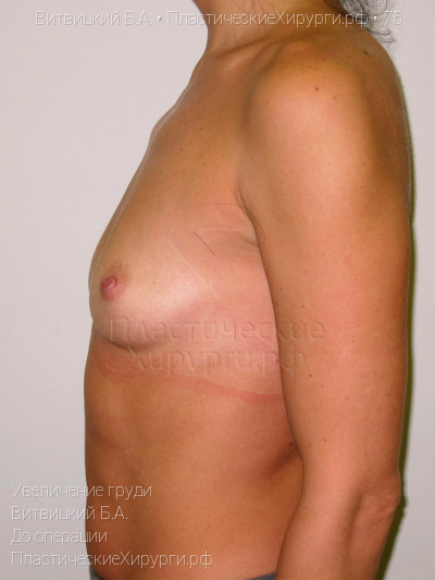 увеличение груди, пластический хирург Витвицкий Б. А., результат №75, ракурс 4, фото до операции