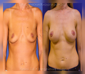 увеличение груди, результат №362, предварительное изображение до и после операции