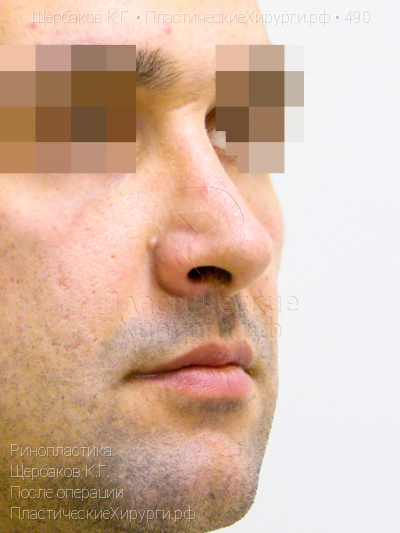 ринопластика, пластический хирург Щербаков К. Г., результат №490, ракурс 2, фото после операции