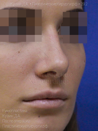 ринопластика, пластический хирург Кузин Д. А., результат №392, ракурс 2, фото после операции