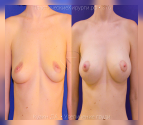 увеличение груди, результат №376, предварительное изображение до и после операции