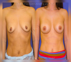 увеличение груди, результат №363, предварительное изображение до и после операции