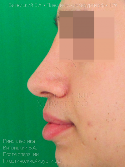 ринопластика, пластический хирург Витвицкий Б. А., результат №179, ракурс 5, фото после операции