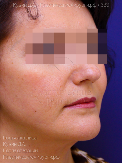 подтяжка лица, пластический хирург Кузин Д. А., результат №333, ракурс 2, фото после операции