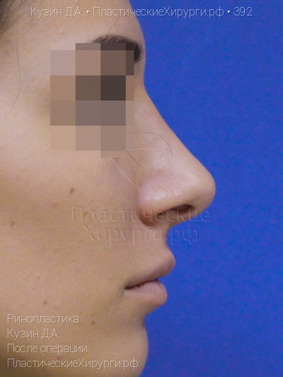 ринопластика, пластический хирург Кузин Д. А., результат №392, ракурс 3, фото после операции