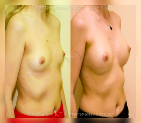 увеличение груди, результат №410, предварительное изображение до и после операции