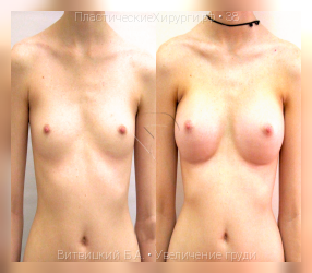 увеличение груди, результат №38, предварительное изображение до и после операции