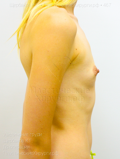 увеличение груди, пластический хирург Щербаков К. Г., результат №467, ракурс 3, фото до операции
