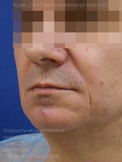 эндоскопическая подтяжка нижней трети лица, пластический хирург Кузин Д. А., результат №330, ракурс 2, фото до операции