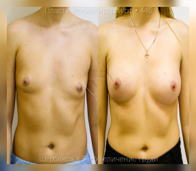 увеличение груди, результат №445, предварительное изображение до и после операции