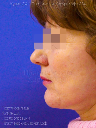 подтяжка лица, пластический хирург Кузин Д. А., результат №334, ракурс 5, фото после операции