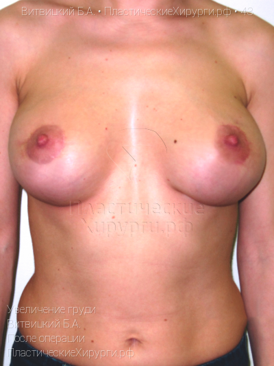 увеличение груди, пластический хирург Витвицкий Б. А., результат №43, ракурс 1, фото после операции