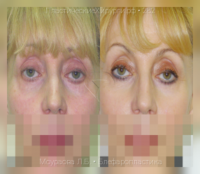 блефаропластика, результат №282, предварительное изображение до и после операции