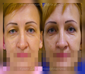 блефаропластика, результат №328, предварительное изображение до и после операции