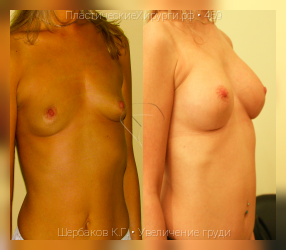 увеличение груди, результат №459, предварительное изображение до и после операции