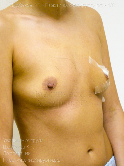 увеличение груди, пластический хирург Щербаков К. Г., результат №431, ракурс 2, фото до операции