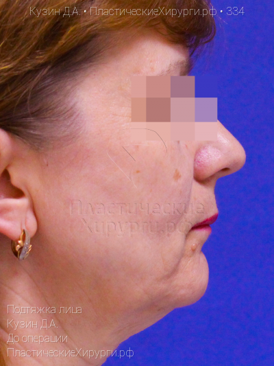подтяжка лица, пластический хирург Кузин Д. А., результат №334, ракурс 3, фото до операции