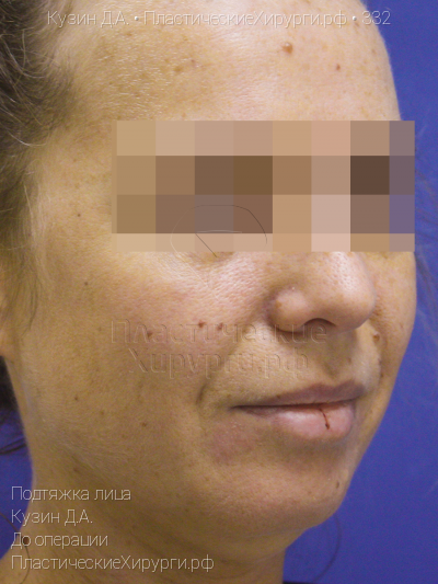 подтяжка лица, пластический хирург Кузин Д. А., результат №332, ракурс 2, фото до операции