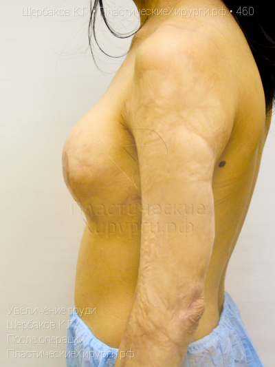 увеличение груди, пластический хирург Щербаков К. Г., результат №460, ракурс 5, фото после операции