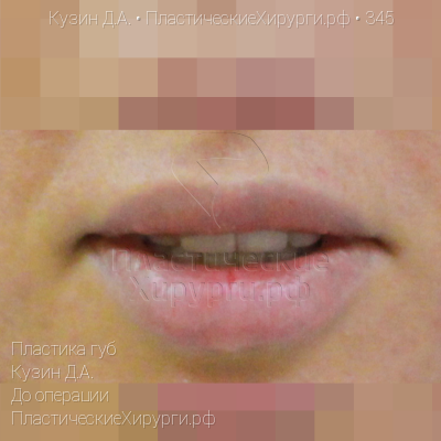 пластика губ, пластический хирург Кузин Д. А., результат №345, ракурс 2, фото до операции