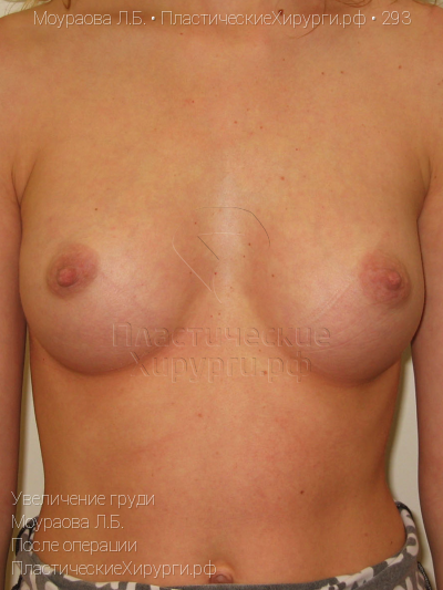 увеличение груди, пластический хирург Моураова Л. Б., результат №293, ракурс 1, фото после операции