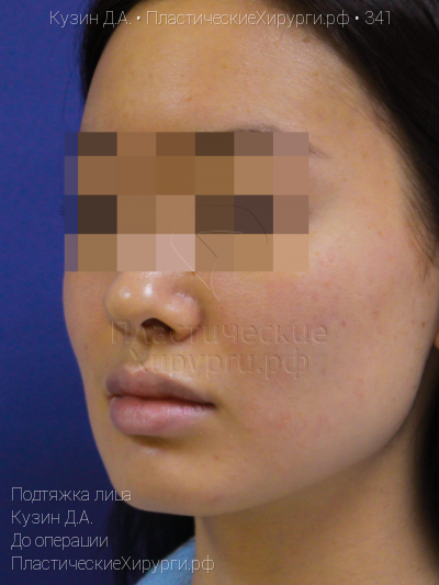подтяжка лица, пластический хирург Кузин Д. А., результат №341, ракурс 2, фото до операции