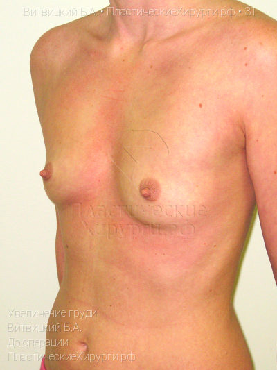 увеличение груди, пластический хирург Витвицкий Б. А., результат №31, ракурс 1, фото до операции