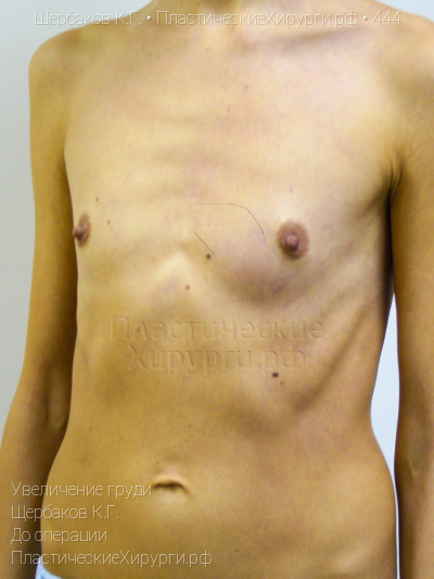 увеличение груди, пластический хирург Щербаков К. Г., результат №444, ракурс 4, фото до операции