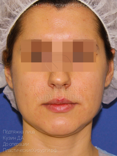подтяжка лица, пластический хирург Кузин Д. А., результат №342, ракурс 1, фото до операции