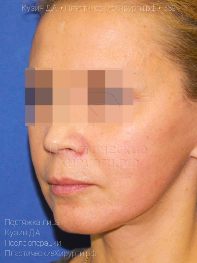 подтяжка лица, пластический хирург Кузин Д. А., результат №339, ракурс 2, фото после операции