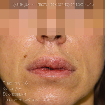 пластика губ, пластический хирург Кузин Д. А., результат №346, ракурс 1, фото до операции