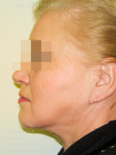 подтяжка лица, пластический хирург Кузин Д. А., результат №344, ракурс 3, фото после операции