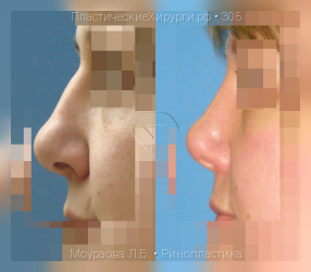 ринопластика, результат №305, предварительное изображение до и после операции