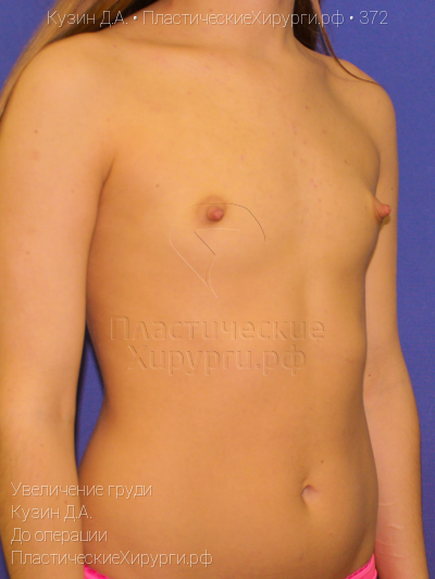 увеличение груди, пластический хирург Кузин Д. А., результат №372, ракурс 2, фото до операции