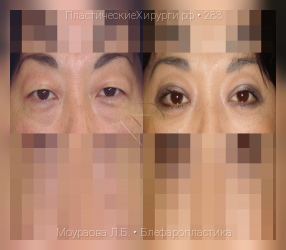 блефаропластика, результат №283, предварительное изображение до и после операции