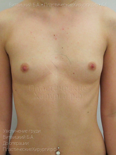 увеличение груди, пластический хирург Витвицкий Б. А., результат №64, ракурс 1, фото до операции