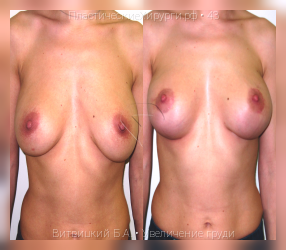 увеличение груди, результат №43, предварительное изображение до и после операции