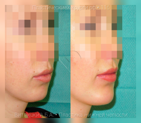 пластика нижней челюсти, результат №116, предварительное изображение до и после операции
