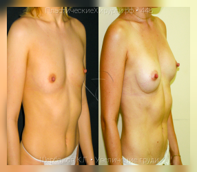 увеличение груди, результат №448, предварительное изображение до и после операции