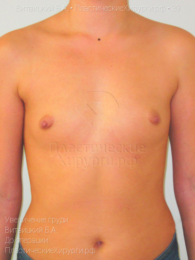 увеличение груди, пластический хирург Витвицкий Б. А., результат №39, ракурс 1, фото до операции