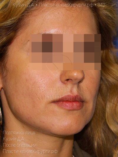 подтяжка лица, пластический хирург Кузин Д. А., результат №342, ракурс 2, фото после операции