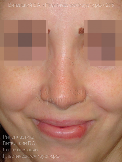 ринопластика, пластический хирург Витвицкий Б. А., результат №275, ракурс 1, фото после операции