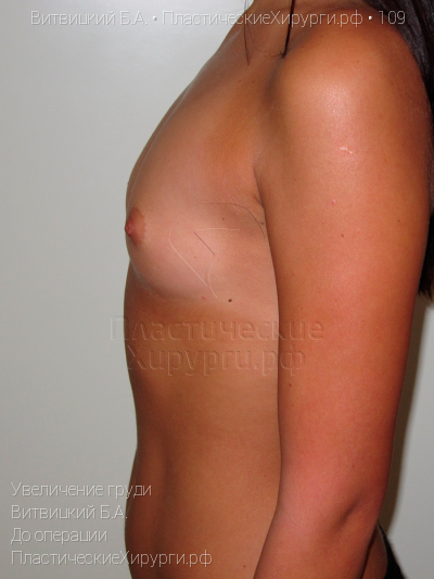 увеличение груди, пластический хирург Витвицкий Б. А., результат №109, ракурс 4, фото до операции