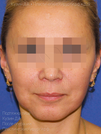 подтяжка лица, пластический хирург Кузин Д. А., результат №339, ракурс 1, фото после операции