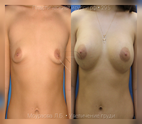увеличение груди, результат №295, предварительное изображение до и после операции