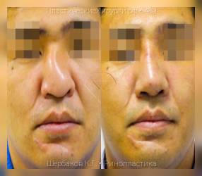 ринопластика, результат №489, предварительное изображение до и после операции