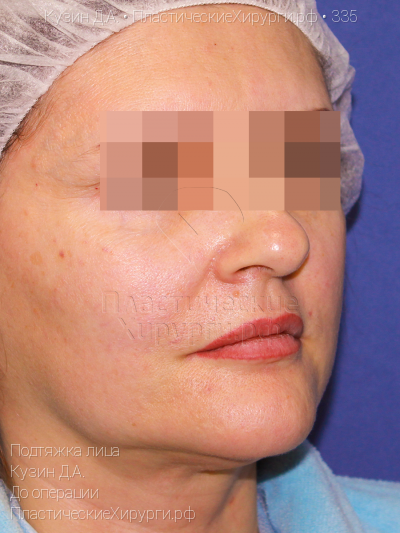 подтяжка лица, пластический хирург Кузин Д. А., результат №335, ракурс 2, фото до операции